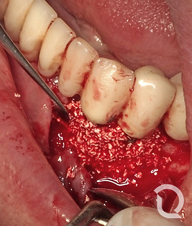 Relleno del defecto con biomaterial para fomentar la regeneración del defecto.