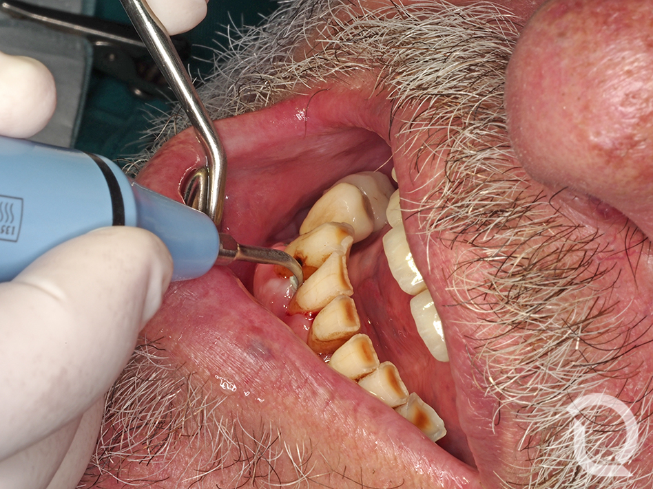 Lo primero es la eliminación del cálculo mediante aparato de ultrasonidos, para que se desprendan las colonias calcificadas.