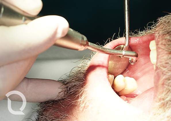 Aplicamos la mezcla de glicina con agua a presión por todas las superficies dentales. La glicina presenta otra ventaja añadida y es una acción antiinflamatoria durante 48h.