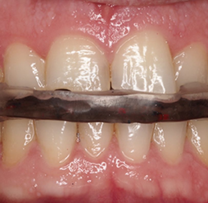 La placa de descarga aparte de proteger el desgaste dental, permitirá la relajación de los músculos que intervienen en la masticación.