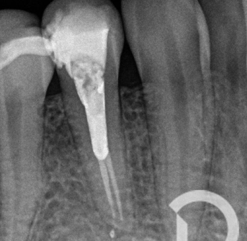 Radiografía final de revisión al año de terminar el retratamiento.
