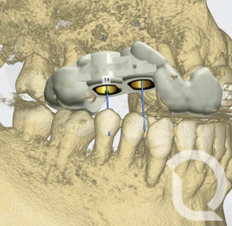 Este es el aspecto de la férula de cirugía guiada en su diseño digital, tras este paso se procede a imprimir en resina con una impresora 3D.