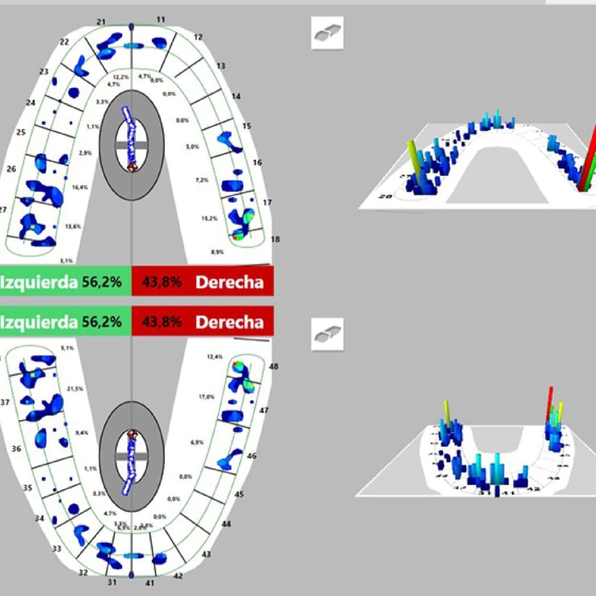 Imagen – Ajuste Oclusal digital Imagen - Ajuste Oclusal digital
