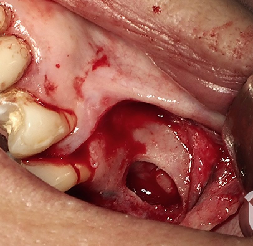 Con la membrana despegada, obtenemos un espacio que será rellenado con biomaterial y así permitir la regeneración.