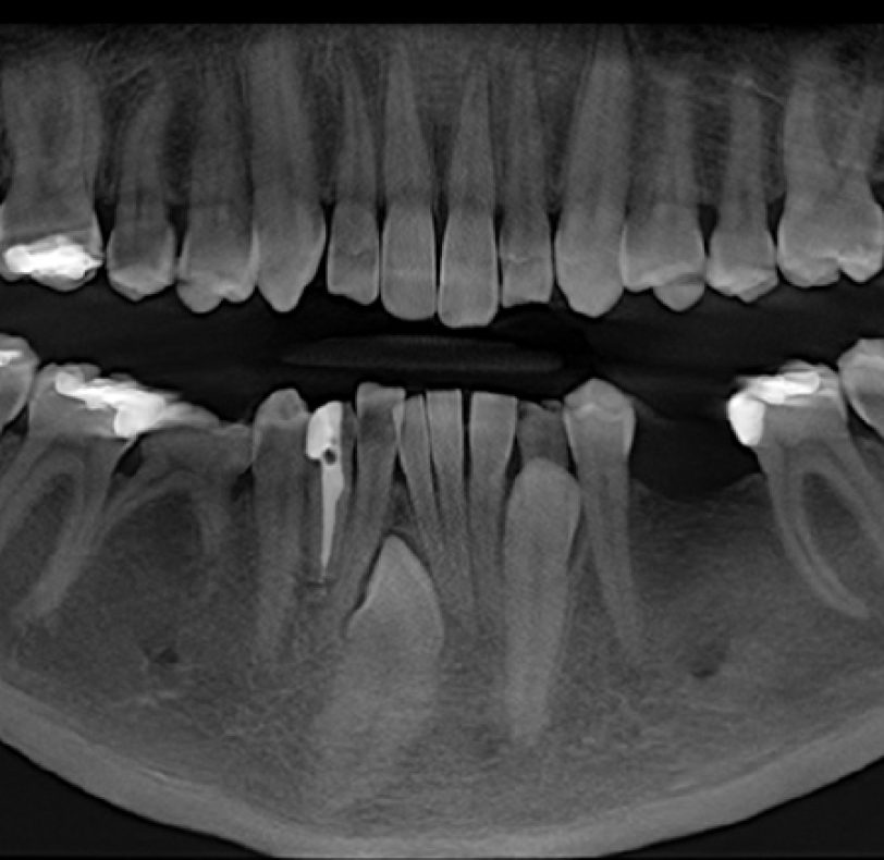 En el estudio radiográfico, se ven las dimensiones en la línea media del canino derecho impactado y la imposibilidad de traccionarlo, se opta por la extracción previo a la ortodoncia. En el futuro se repondrá esa pieza con una prótesis implanto soportada.