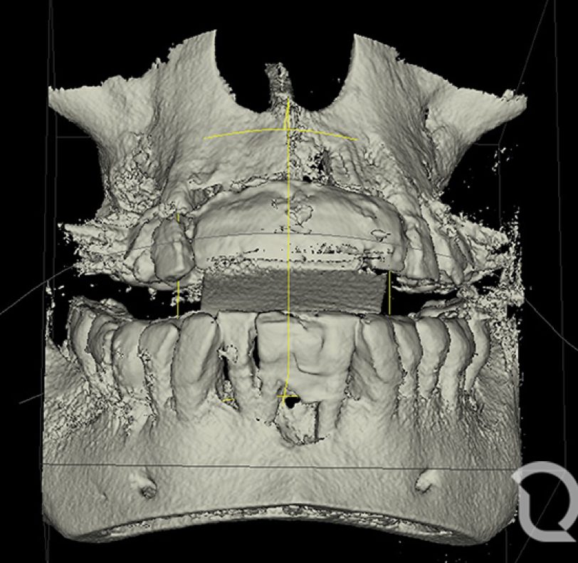 En la reconstrucción digital basada en la radiografía 3D, observamos hasta donde llega el nivel óseo de la zona afectada.