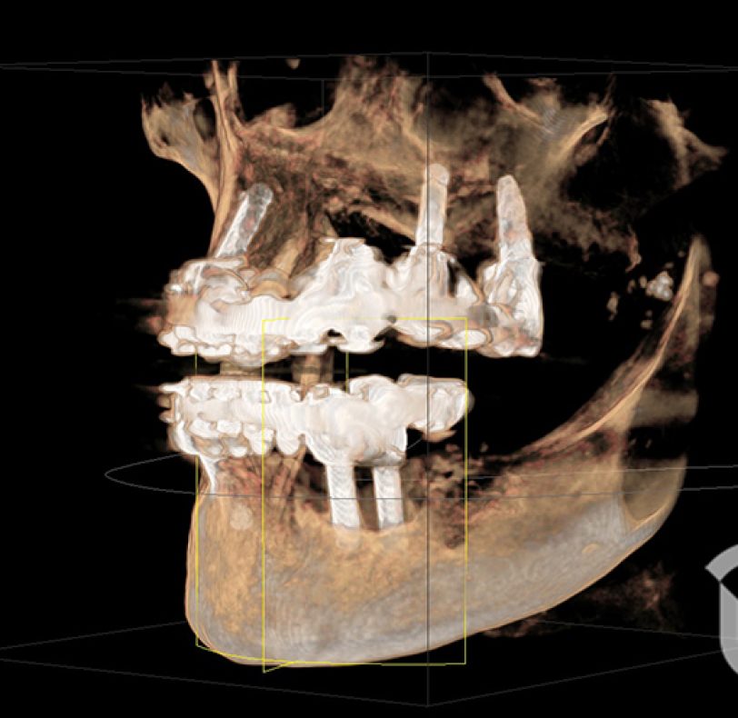 Mediante el hallazgo radiológico vemos una pérdida ósea al resdedor de los implantes dentales de este puente inferior (enmarcado en amarillo en la reconstrucción 3D)