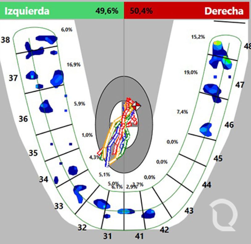 Las líneas de colores que vemos en el centro del mapa de contactos, representan la desviación que hace nuestra mandíbula al tener el primer contacto en cierre y si se desvía del centro, se dibuja una trayectoria que se detiene hasta el contacto estable. Si la desviación se sale dentro de un rango fisiológico, debemos ajustar la oclusión para corregirlo. También podemos ver la intensidad de las fuerzas en la mitad izquierda y derecha, aportando información para un mejor ajuste, un ideal es lograr fuerzas lo más próximas al 50% en ambas partes, confirmando un mayor confort por parte del paciente.