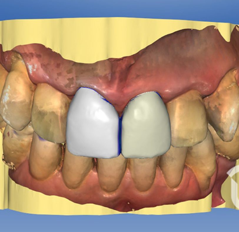 Diseño Cad-Cam de las coronas provisionales. Al ser un provisional, en este diseño vamos a unir ambas coronas para que la estructura ofrezca más resistencia, a la espera de la fabricación de las coronas de porcelana sin metal de disilicato.