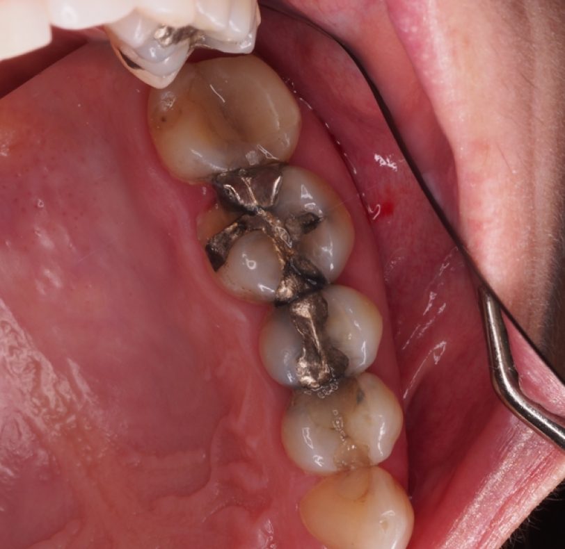 La paciente acude con una amalgama de plata que presenta una fractura en la cúspide palatina